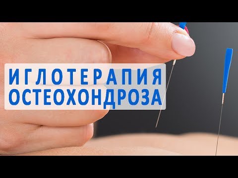 Иглотерапия (иглоукалывание) при