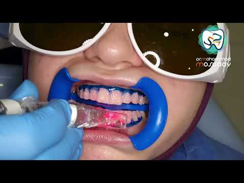 فيديو: ما هي تكلفة تبييض الأسنان المهنية؟