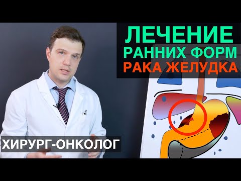 Рак желудка - лечение ранних форм рака желудка