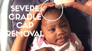 Newborn Cradle Cap Removal | Rash All Over