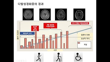 다발성경화증의 치료 (1)