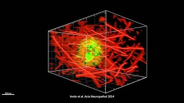 Three dimensional immunohistological visualization of Aβ and neurofilament in a human post mortem AD