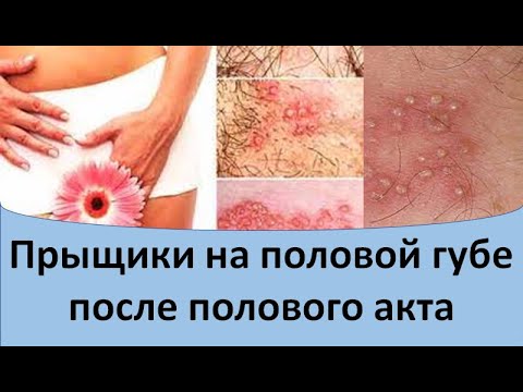 Прыщики на половой губе после полового акта