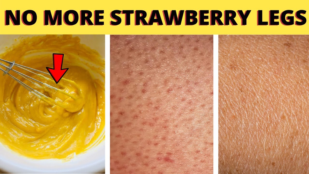 No More Strawberry Legs - DIY Leg Scrub To Easily Get Rid Of Strawberry ...