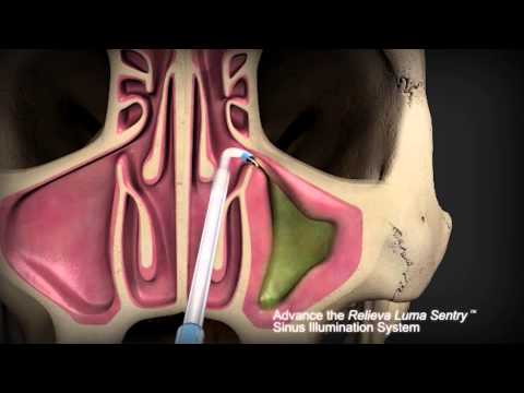How is septoplasty surgery performed?