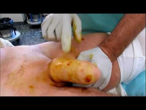 FTM Phalloplasty -- Inflatable vs. Semi-Rigid Penile Implants