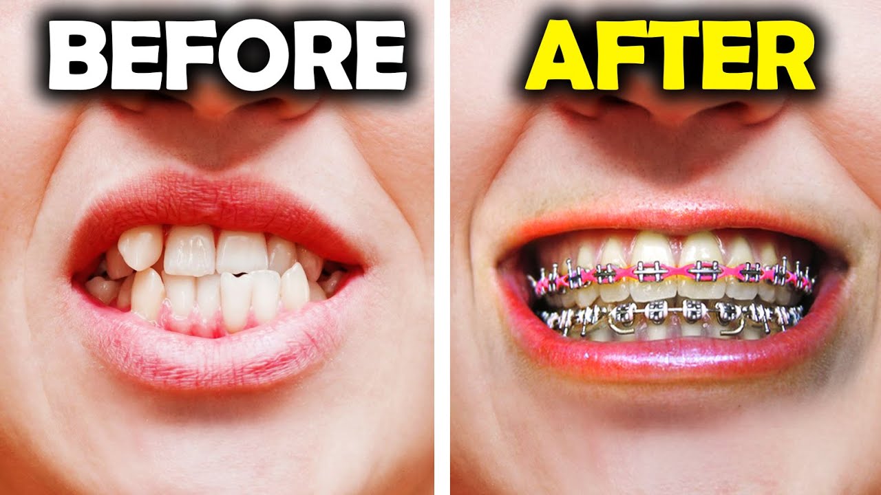 GETTING BRACES Power Chain YouTube