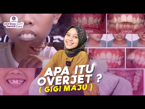 Video: Bagaimana cara mengatasi overbite tanpa kawat gigi?