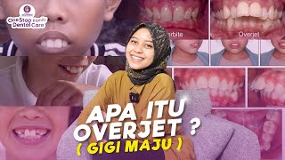 APA ITU OVERJET ? BAGAIMANA MENANGANI GIGI MAJU ?