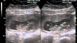 Nosso Bebe Com 12 Semanas