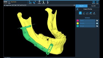 #AI-based segmentation, 3D modelling and Cutting Guides for Maxillofacial Surgical Applications