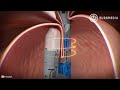 Endoscopic treatment for  gastroesophageal reflux disease gerd or known as acid reflux