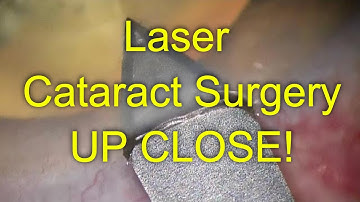 Routine laser cataract surgery - Up Close! -  Dr Simon Chen