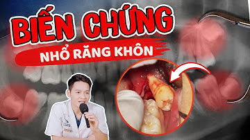 Nhổ Răng Khôn Có Nguy Hiểm Không? 7 Biến Chứng Phải Cảnh Giác Khi Nhổ Răng Khôn