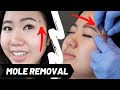 I Filmed My Entire Facial Mole Removal // Here Is My Experience & What To Expect (Mole Shaving)