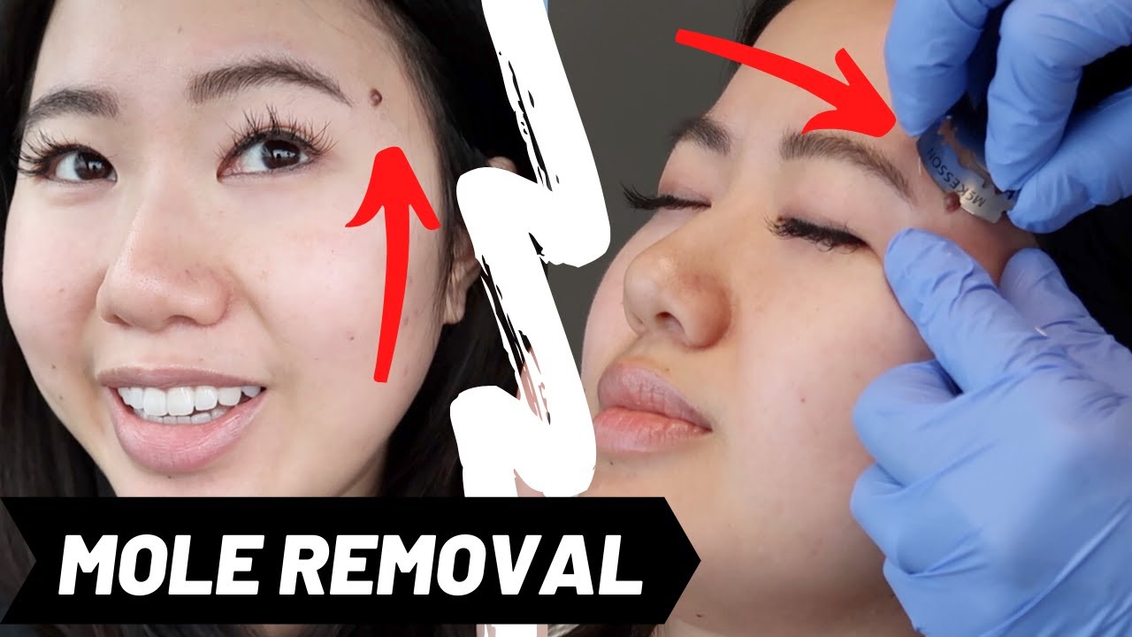 LASER MOLE REMOVAL - YouTube