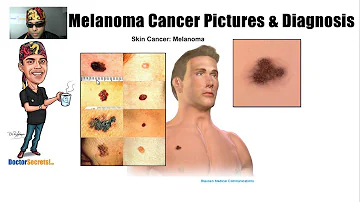 Come capire se si ha un melanoma?