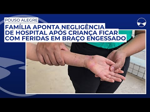 Família aponta negligência de hospital após criança ficar com feridas em braço engessado