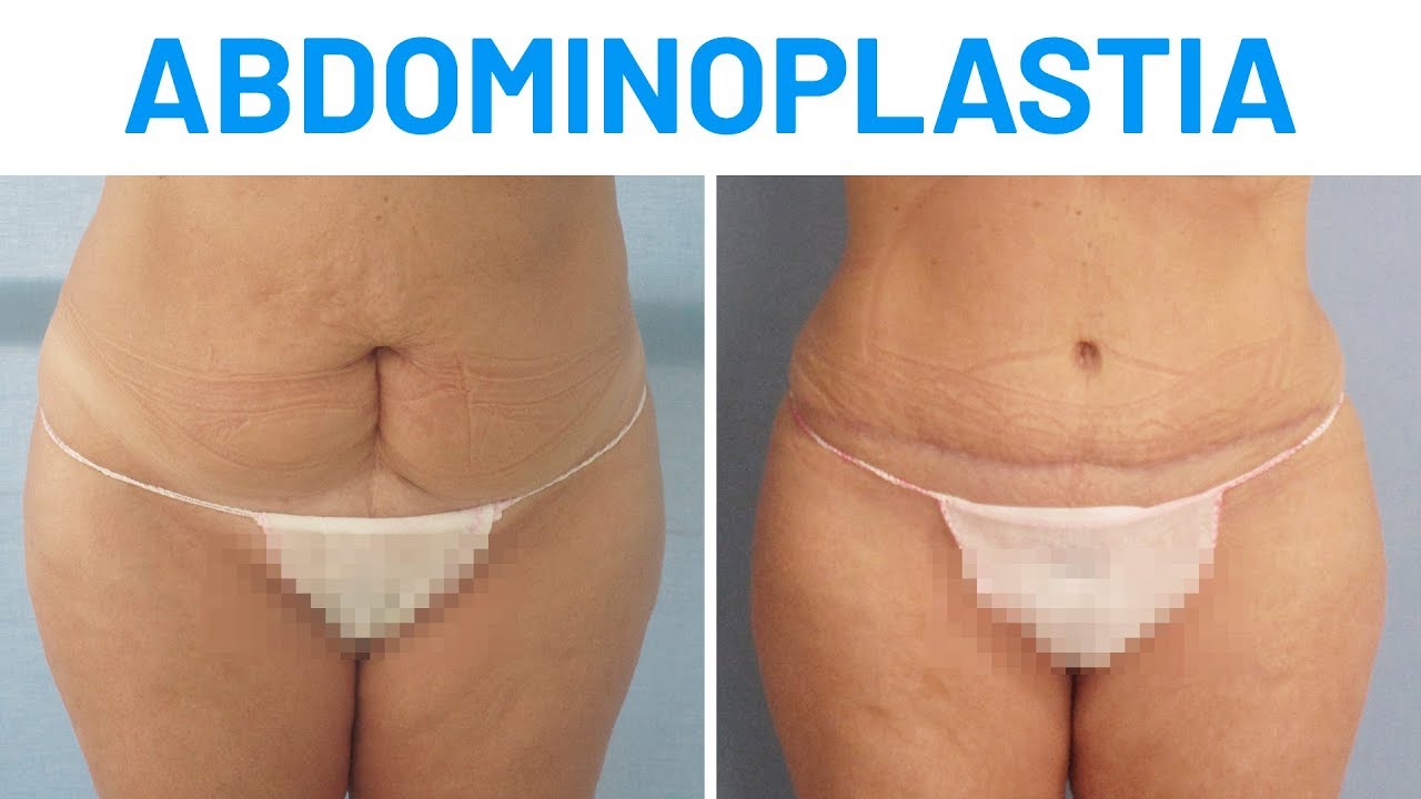 Cuanto cuesta una abdominoplastia en españa