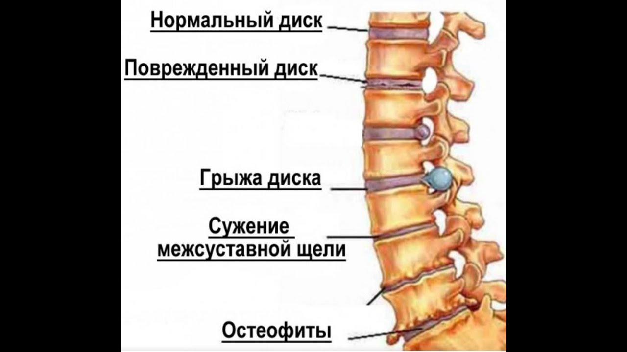 Поставили остеохондроз. Остеохондроз th5-th8. Остеохондроз грудного отдела позвоночника симптомы. Остеохондроз грудного и поясничного отдела. Стадии развития остеохондроза.