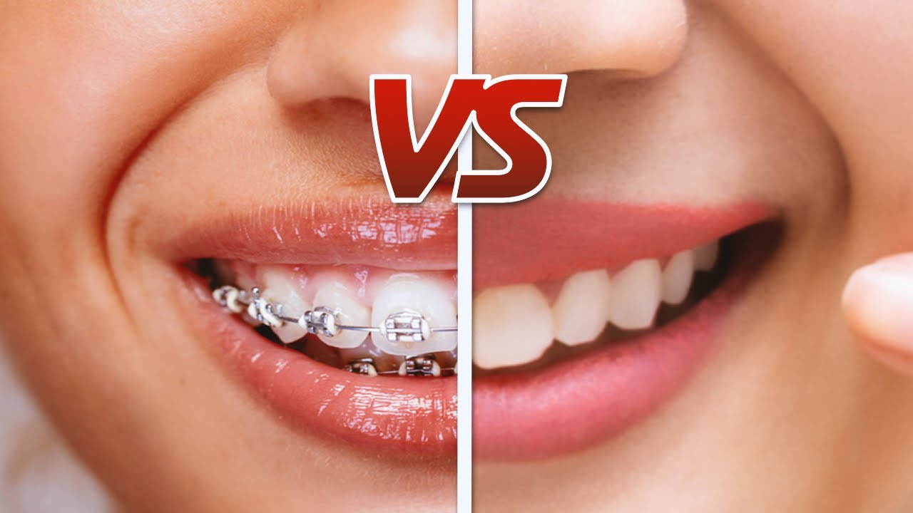 Braces Or Invisalign Difference Explained In 60 Seconds Youtube 