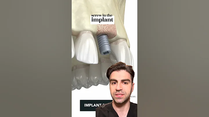 Tooth Implant Procedure {STEP BY STEP} - Explained
