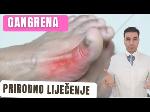 GANGRENA-5 prirodnih načina liječenja!