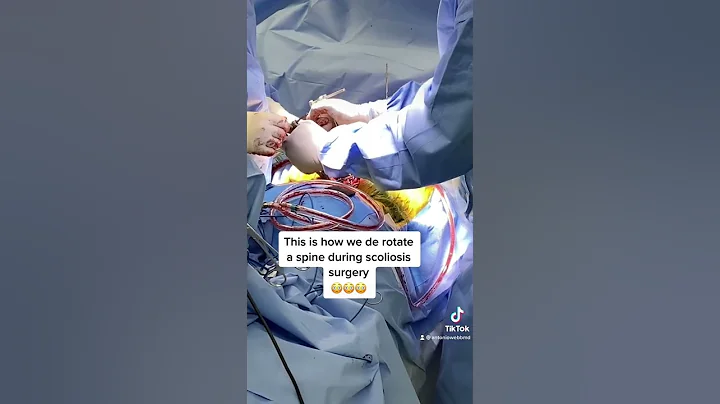 DeRotating a 75 degree Scoliosis Curve!