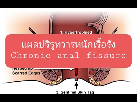 แผลปริรูทวารหนักเรื้อรัง Chronic anal fissure