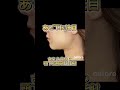 さえら先生のアゴ下脂肪吸引注射!