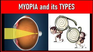 Unveiling the Secrets of Myopia: Exploring Various Types and Causes