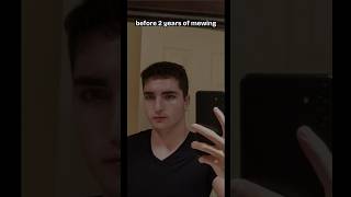 Before and after mewing transformation 2 years #mewingbeforeandafter #mewingresults