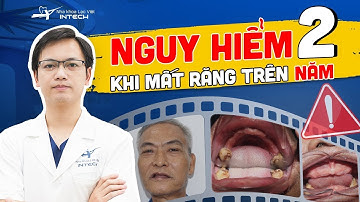 Tiêu Xương Hàm: 3 Thời Điểm Tiêu Xương Hàm Và Nguy Hiểm Nhất Định Phải Biết