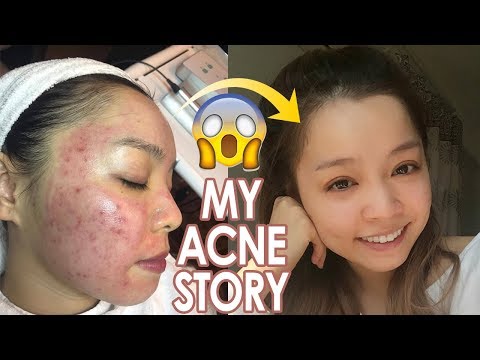 Nhật Kí Trị Mụn của Trinh ♡ My Acne Story ♡ Trinh Pham