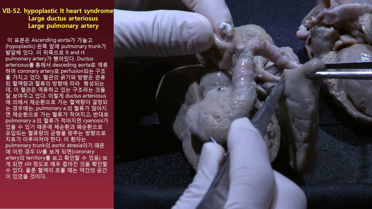 VII. HLHS-52. hypoplastic It heart syndrome