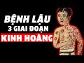 3 giai đoạn KINH HOÀNG của bệnh LẬU - Dùng chung khăn tắm cũng lây!!