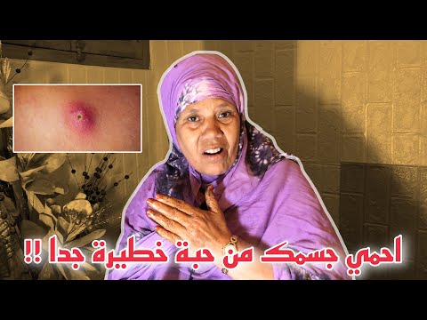 التخلص من حبة ام جلود بأسهل طريقة
