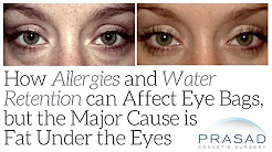 How Allergies and Water Retention can Affect Eye Bags, but the Major Cause is Fat Under the Eyes
