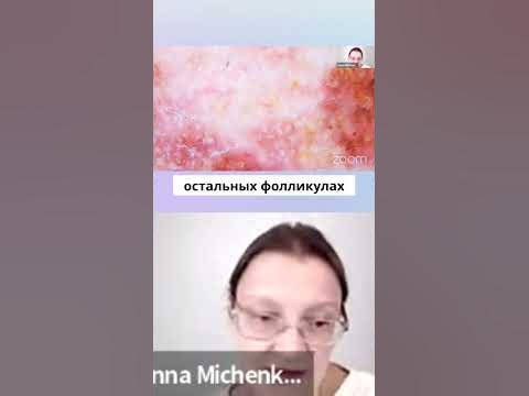 Лентиго меланома часть 4 - YouTube