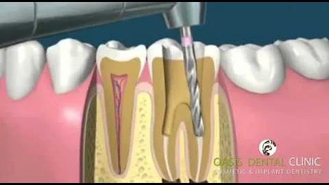 Endodontic - Root Canal