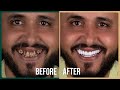 Hollywood smile en turquie   exprience honnte de m belayadi