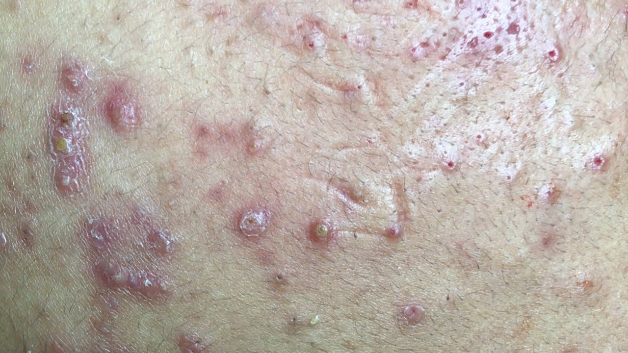 AWESOME INFLAMED BLACKHEADS FIELD | Full Treatment [ 46m 30s ]