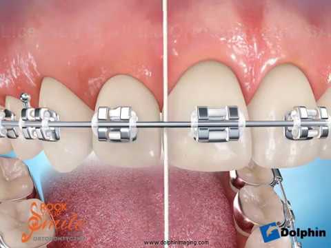 Wideo: 5 sposobów na czyszczenie aparatów ortodontycznych