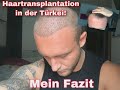 Haartransplantation Türkei / Johanns DOKU