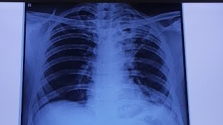 pulmonary TB KOCHS CHEST X RAY