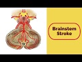 Brainstem Stroke Syndromes