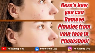 Here's how you can Remove Pimples from your face in Photoshop!  #photoshop log #photography