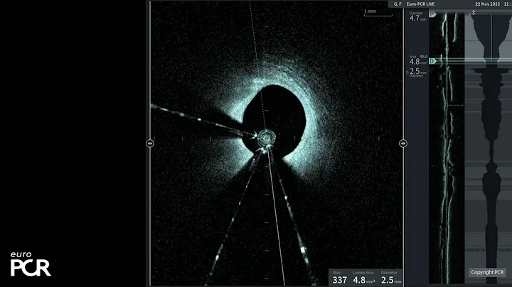 Left main and complex bifurcation stenting - EuroPCR 2025