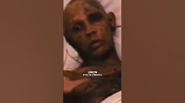 Scary Aftermath Unveiling Acute Radiation Sickness Photo Post Chernobyl Shorts 