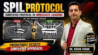 SPIL Protocol (Simplified Protocol in Immediate Loading) by Dr. Rohan Virani |Patient Transformation
